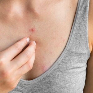 mulher-jovem-com-alergia-cutanea